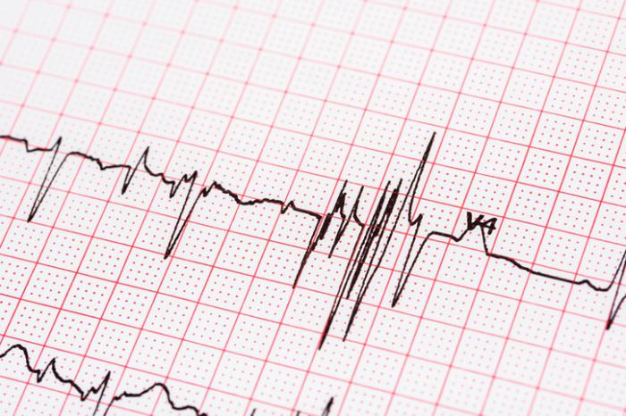 EKG results A-fib: Characteristics, types, symptoms, and treatment