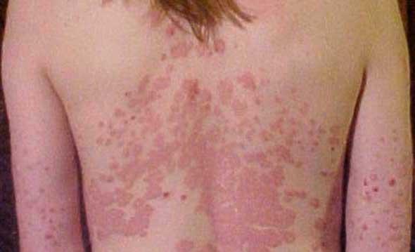erythrodermic psoriasis image credit james heilman md 2010