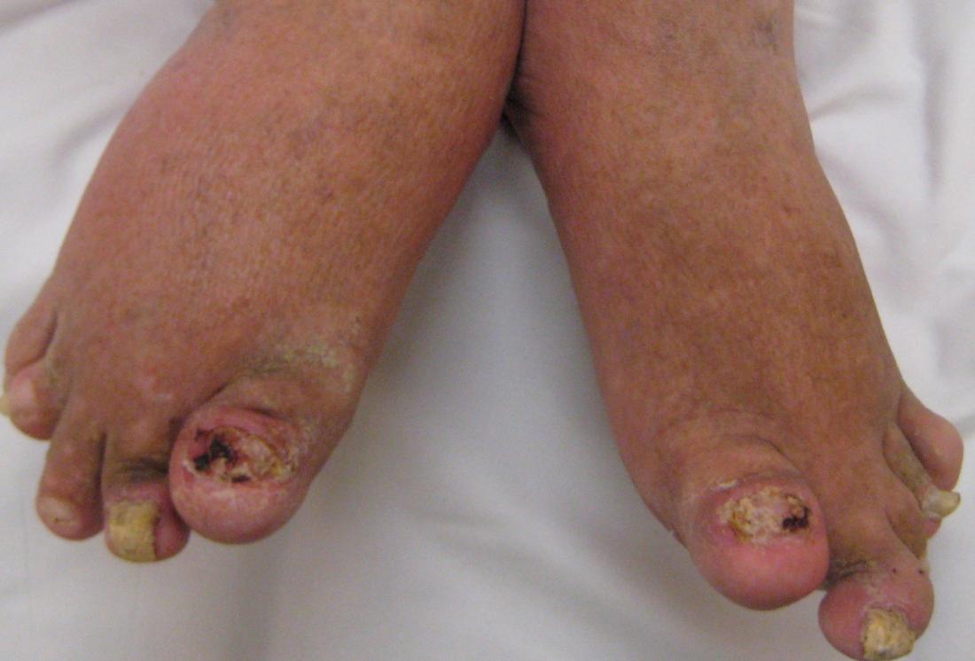 Psoriatic arthritis feet