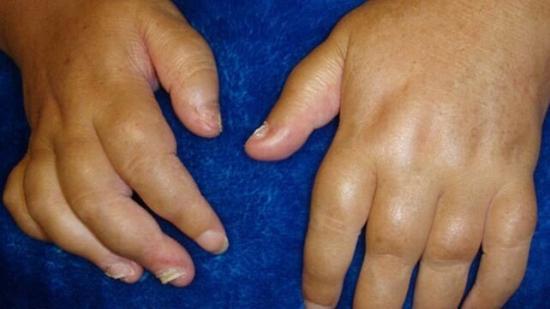 Swollen fingers