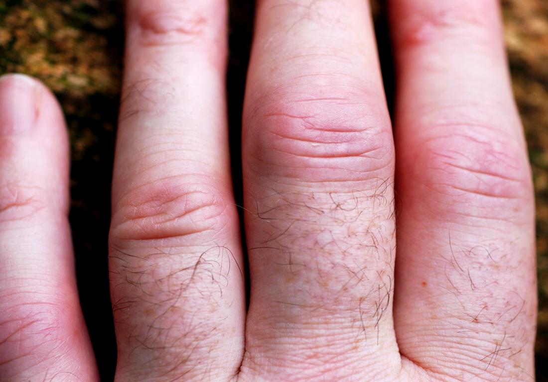 swollen fingers for rheumatoid psoriatic arthritis