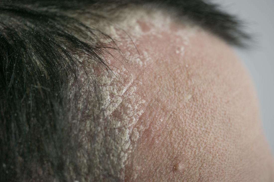 Psoriasis or dandruff? Symptoms, treatment, and tips