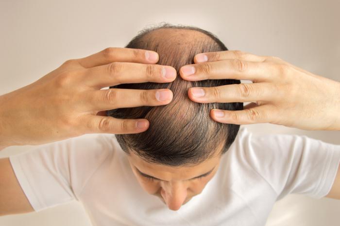 Hair Loss Treatments For Men Best Options