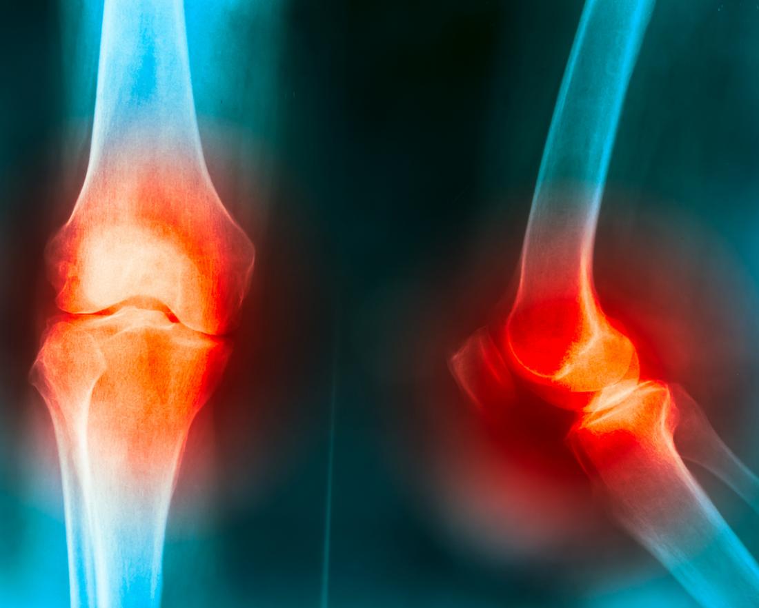 https://cdn-prod.medicalnewstoday.com/content/images/articles/317/317205/knee-joint-pain.jpg