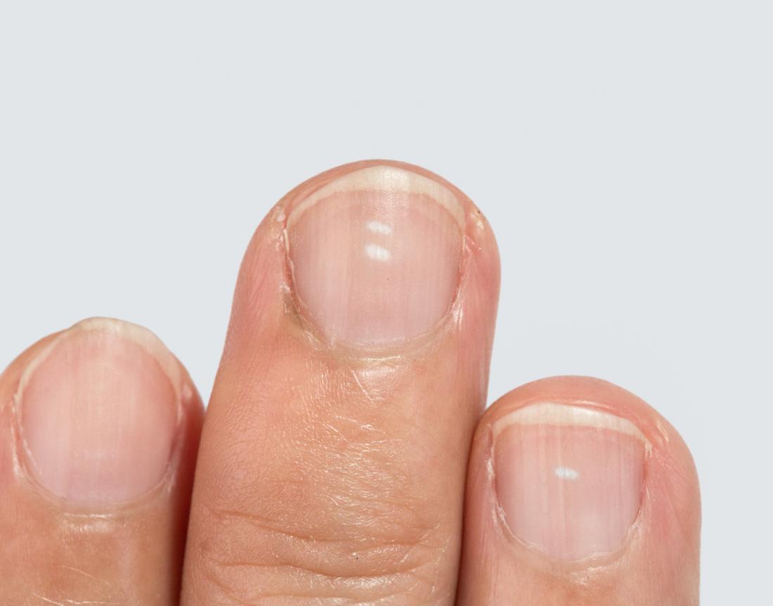 White spots on nails: Causes, prevention, and treatment