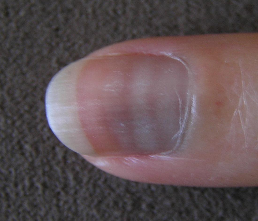 The Black Line on Nail: Is It Splinter Hemorrhages | Credihealth