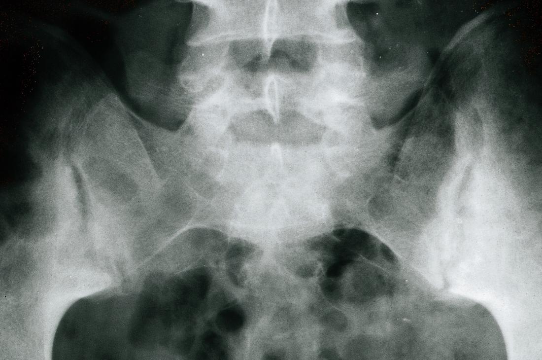 Ankylosing Spondylitis Radiopaedia