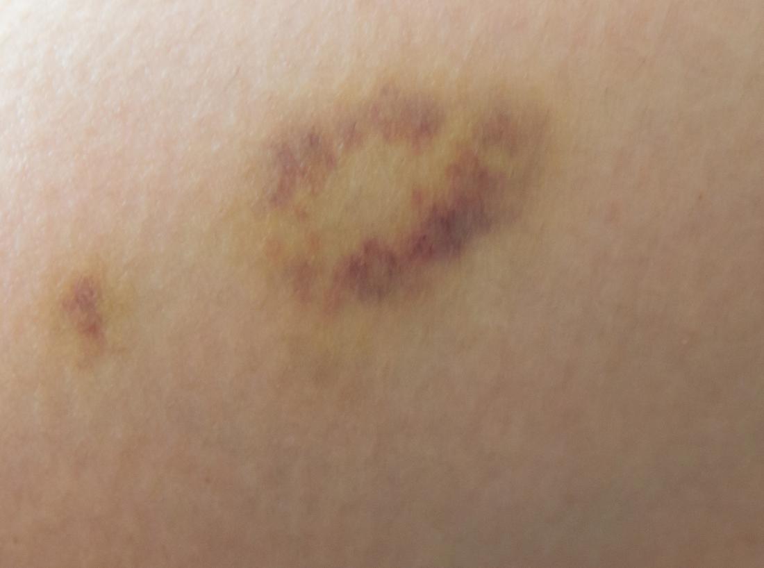 bruise on skin