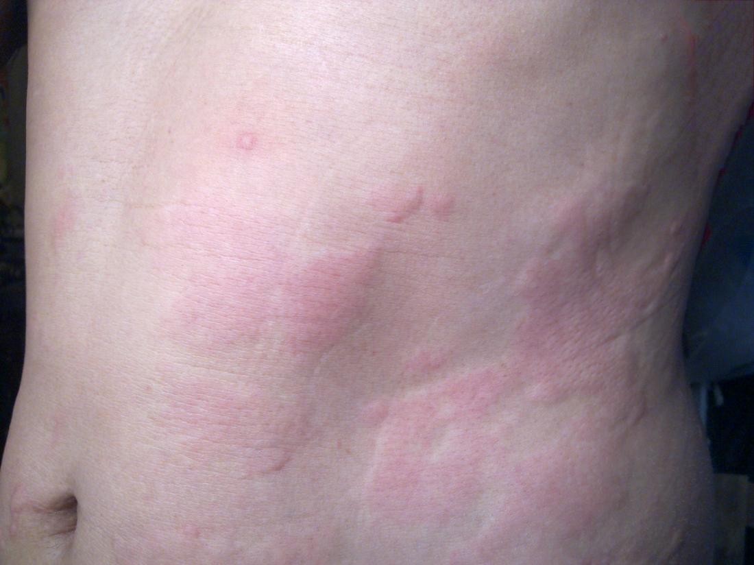 Is It a Stress Rash or Something Else?