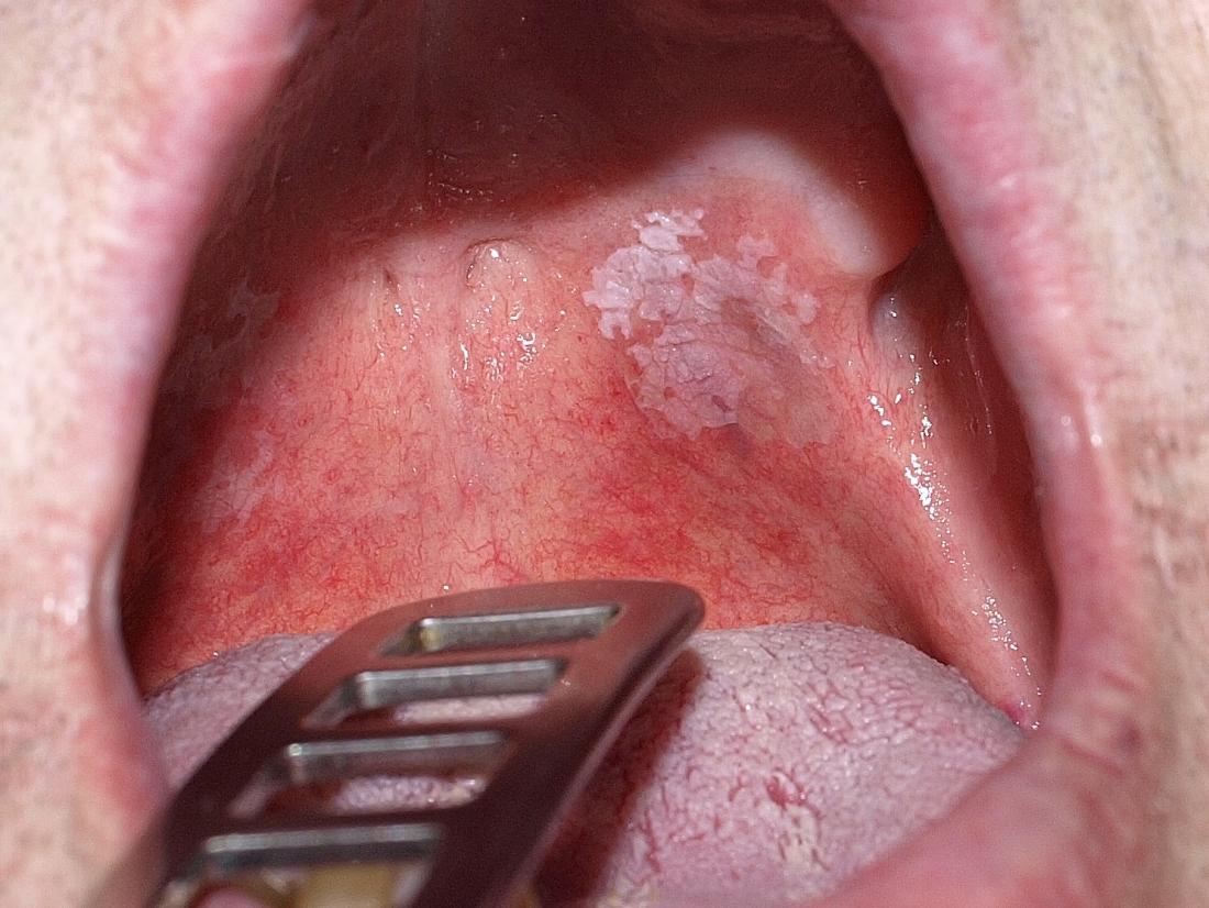 frictional keratosis gums