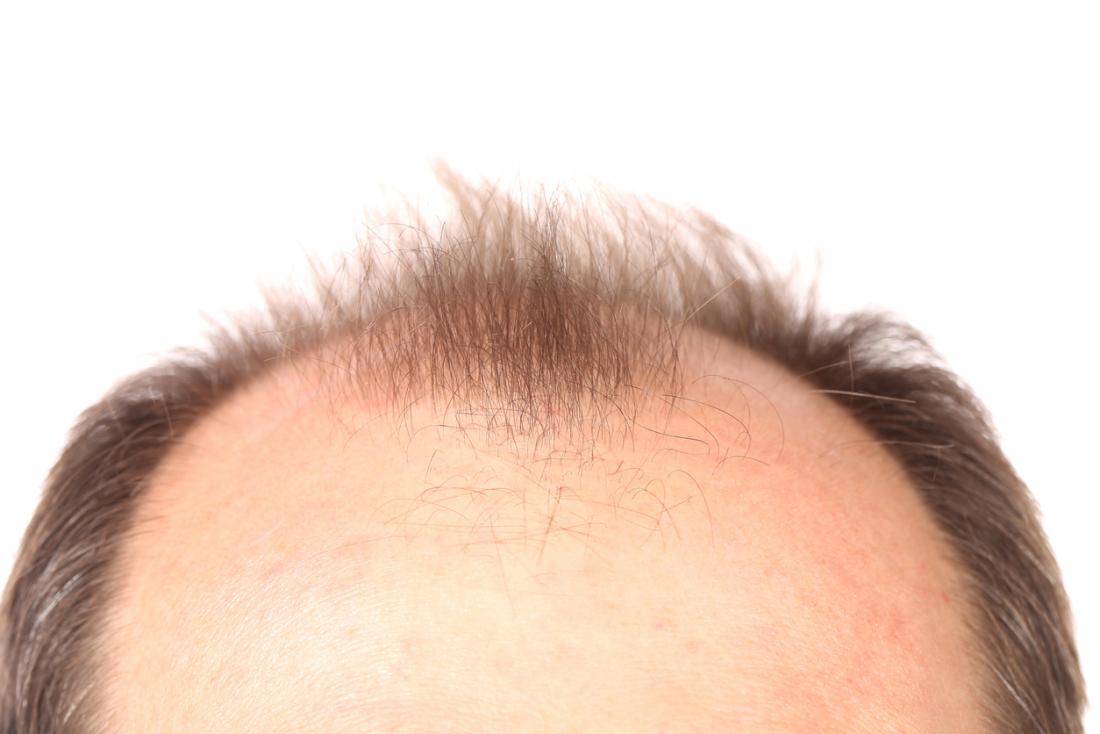 How to Grow Hair Faster on Bald Crown? 5 Hair Re-growth Tips!