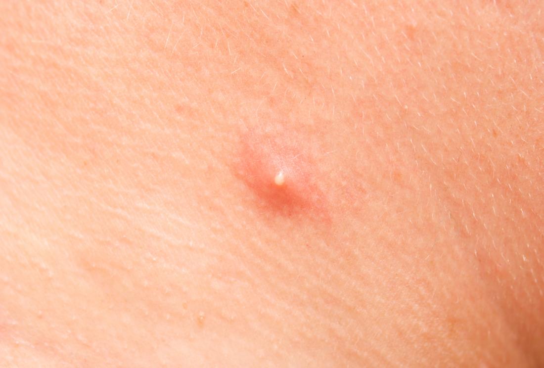Vaginal pimples: Causes, treatment, and prevention