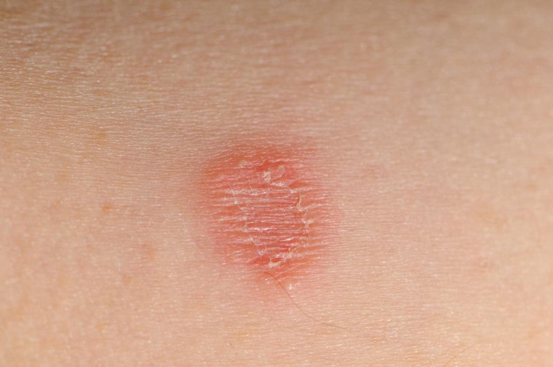 Fungal infections: Symptoms, types, and treatment