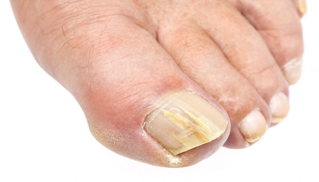 Fungal infections: Symptoms, types, and treatment