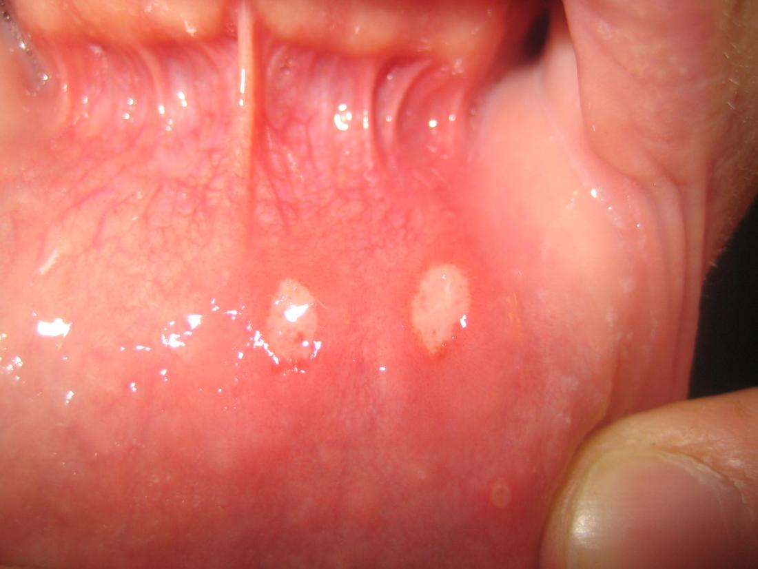 sore inside mouth