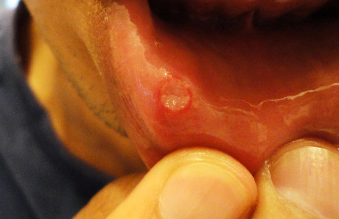 Mouth Ulcers Types Causes Symptoms And Treatment