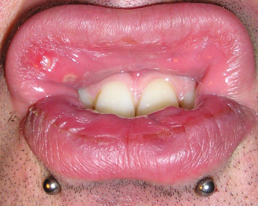 Mouth Ulcers Types Causes Symptoms And Treatment