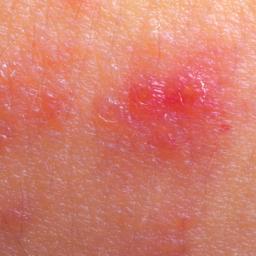 Skin rash: 68 pictures, causes, and treatments