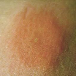 Skin Rash Causes 68 Pictures Of Symptoms And Treatments