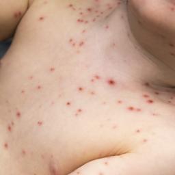 Skin Rash Causes 68 Pictures Of Symptoms And Treatments