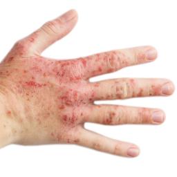 Skin Rash Causes 68 Pictures Of Symptoms And Treatments