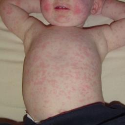 Allergic rash on toddler body