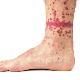 Skin Rash Causes 68 Pictures Of Symptoms And Treatments