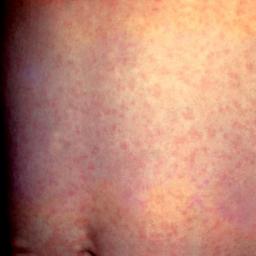 causes of rash purple