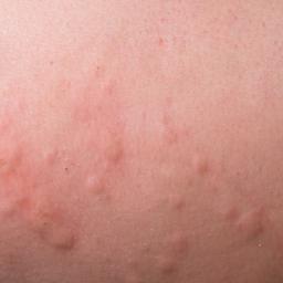 Skin Rash Chart