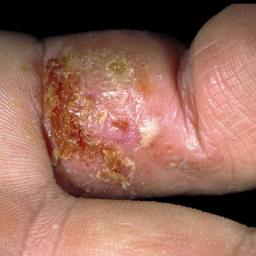 Skin Rash Causes 68 Pictures Of Symptoms And Treatments