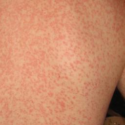 Zákazník rána obrana red spots on skin no itch stuha Desetinný křesťanství