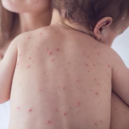 Skin Rash Causes 68 Pictures Of Symptoms And Treatments