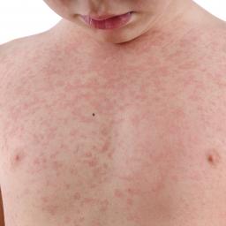 Skin Rash Identification Chart