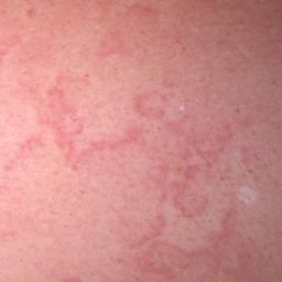 Skin Rash Causes 68 Pictures Of Symptoms And Treatments