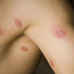 Skin Rash Causes 68 Pictures Of Symptoms And Treatments