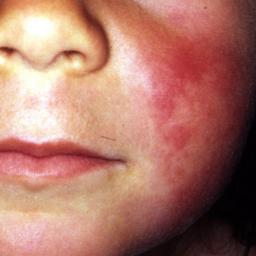 Skin Rash Causes 68 Pictures Of Symptoms And Treatments