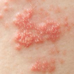 Skin Rash Causes 68 Pictures Of Symptoms And Treatments