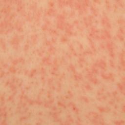 Skin Rash Identification Chart