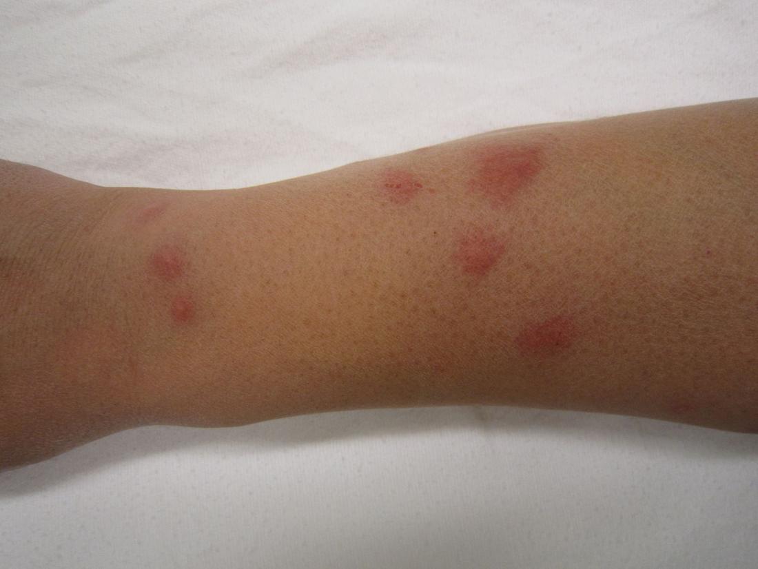 bed bug bites on legs only