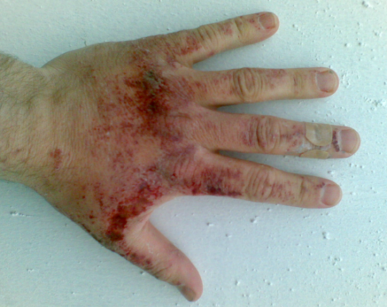 hydrochloric acid burn hand