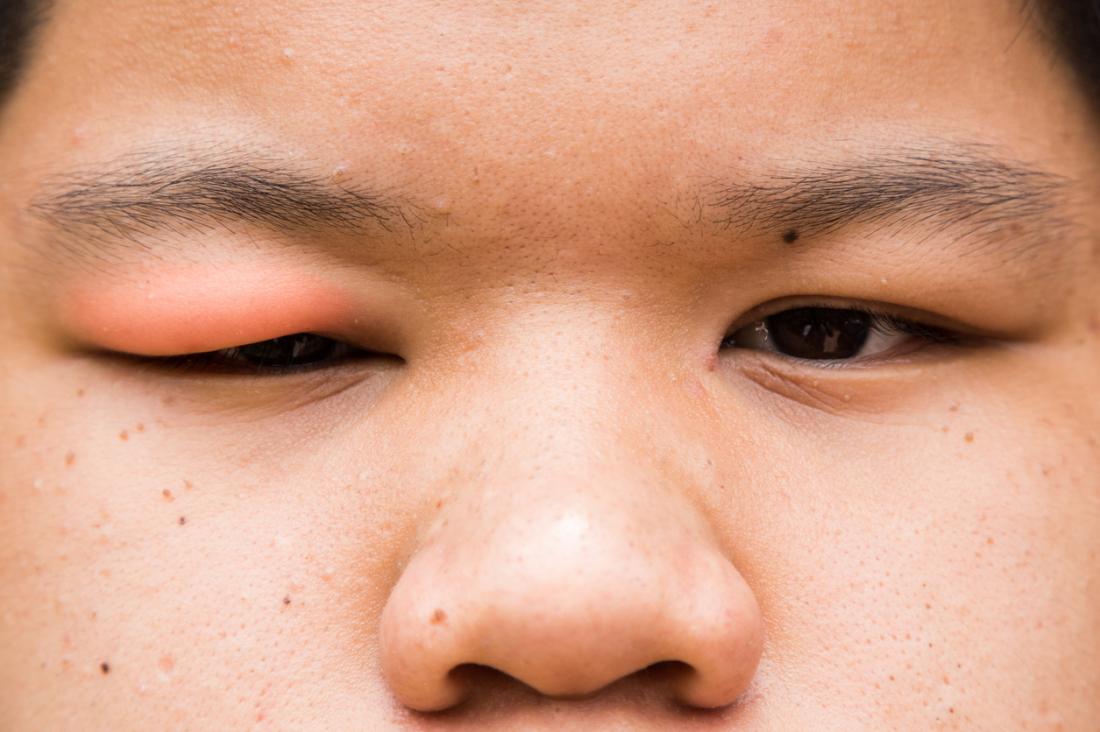 How to get rid of swollen eyes from allergic reaction