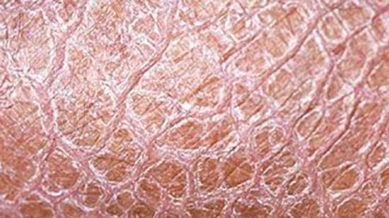 Ichthyosis vulgaris: Pictures, diagnosis, and treatment