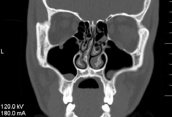CT scan of deviated septum <br>Image credit: Mike Gerkin, 2011</br>