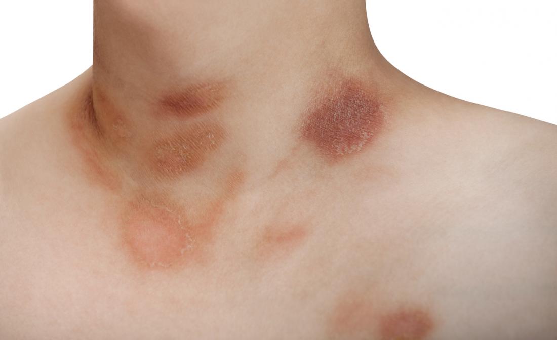 How to deal with rashes around the intimate area?