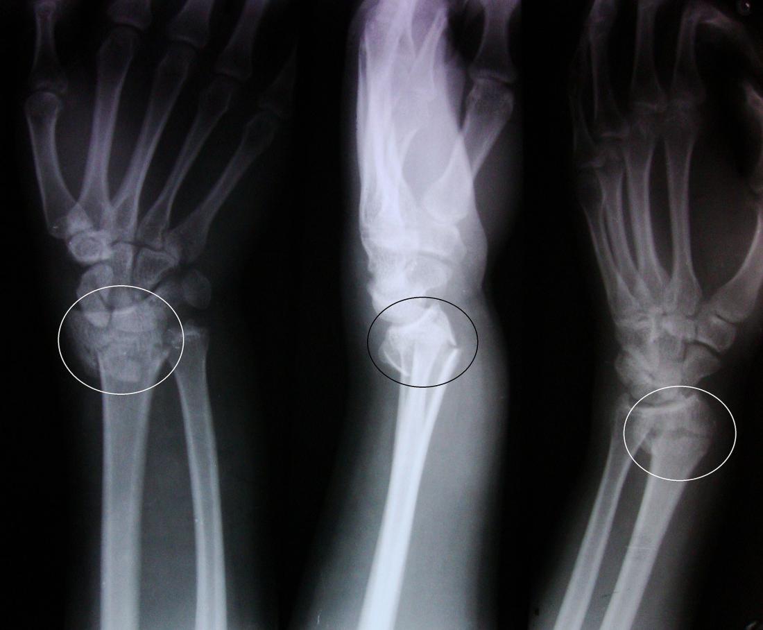 Colles fracture Causes symptoms and diagnosis