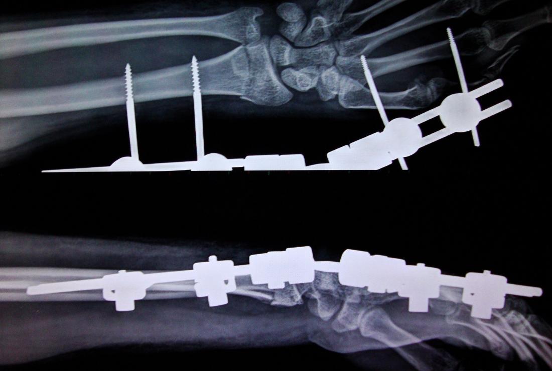 Colles Fracture Definiton – Broken Wrist