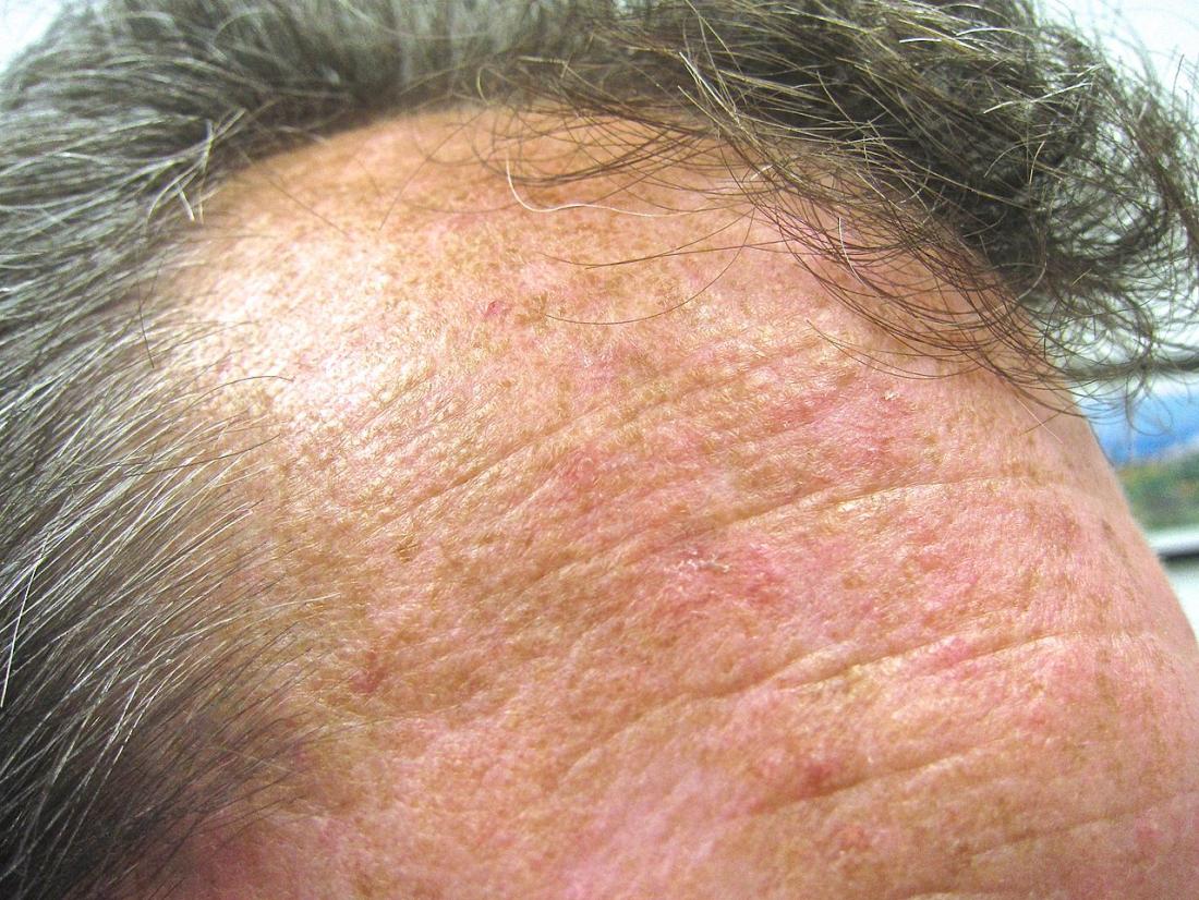 actinic-keratosis-pictures-causes-and-prevention