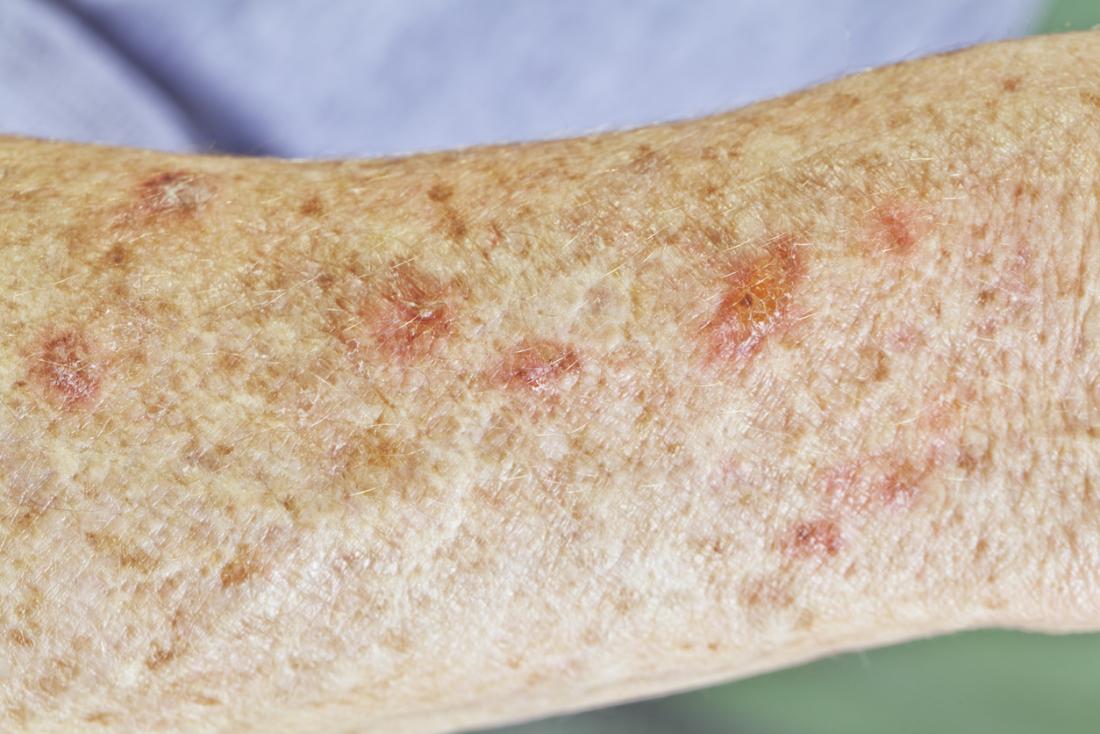 actinic-keratosis-pictures-causes-and-prevention