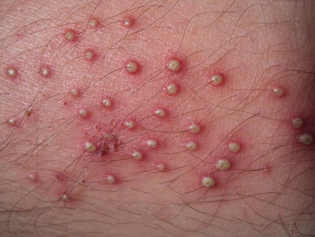 Folliculitis Causes Symptoms And Treatment