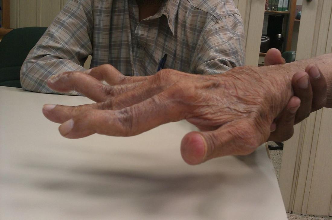 Swan neck deformity <br>Image credit: Phoenix119, 2014.</br>